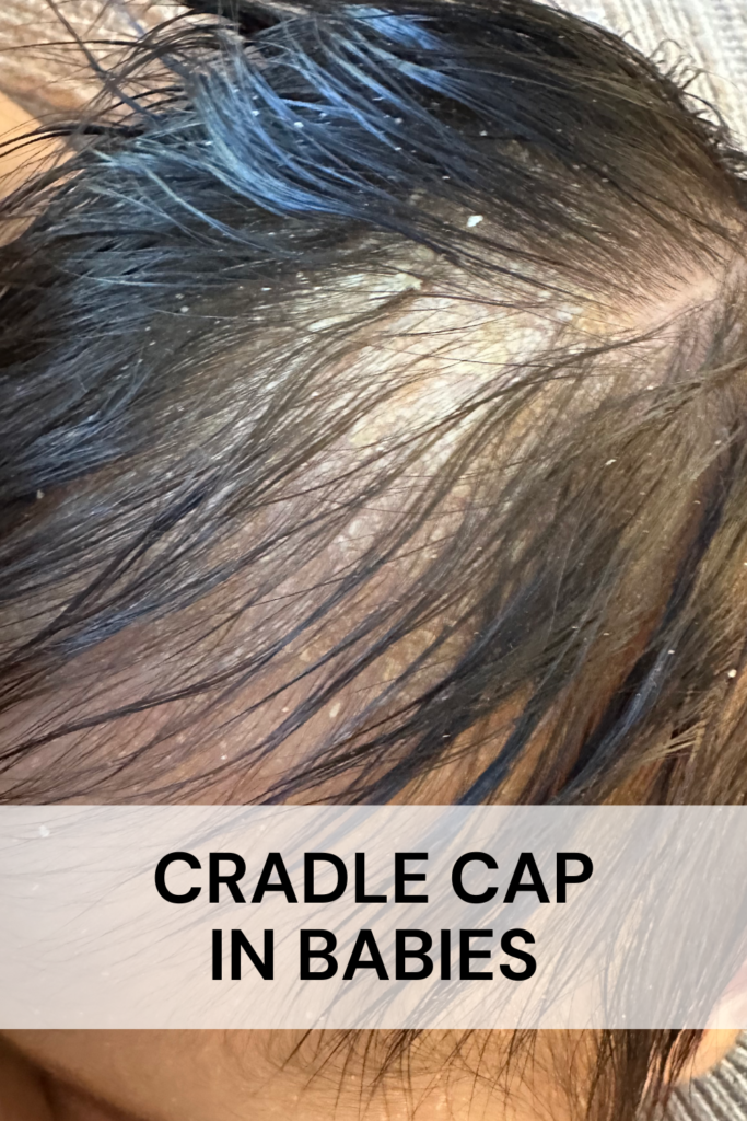 cradle cap in babies